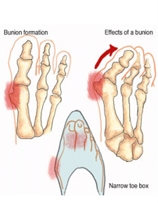 Are Bunions Caused by Shoes? What Research Actually Shows