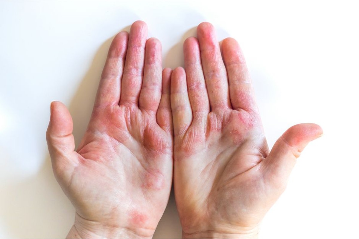 How to Treat Blisters on Your Hands