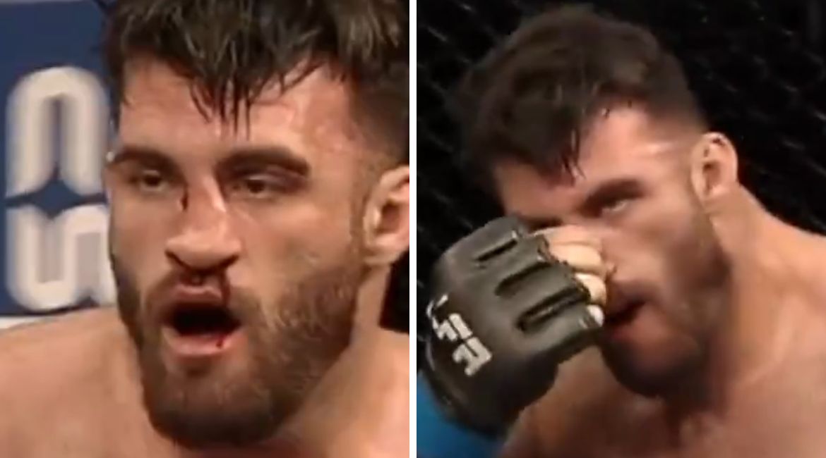 Mauricio Queiroz resets broken nose mid-fight – WATCH