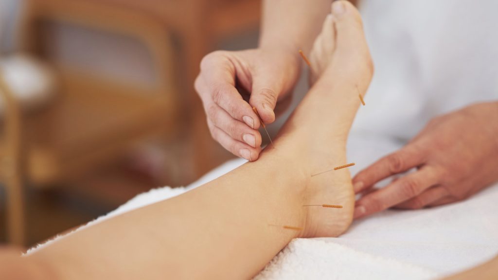 6 Great Benefits of Acupuncture for Runners